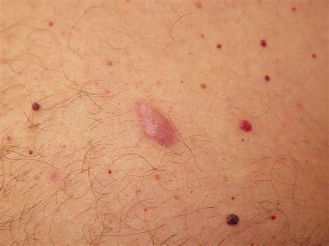 sores on the skin (including blisters, ulcers or warts) flaking, dry skin. . Lump in pubic area male under skin